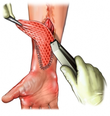 Операция пересадки кожи при ожогах материалы и восстановление