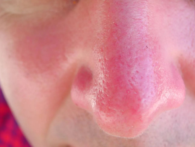 Ожоги слизистой носа как помочь и способы лечения