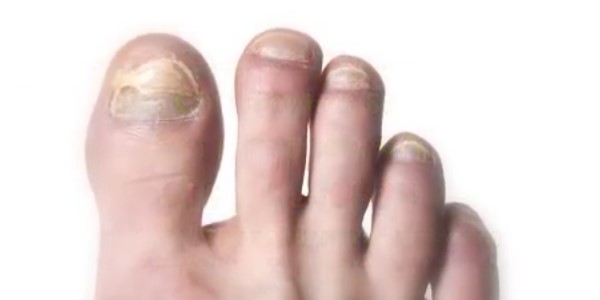 заболевания ногтей
