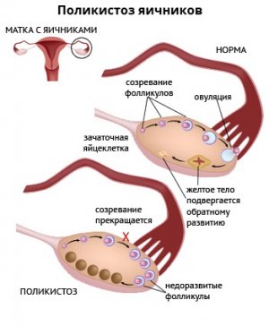 является наличие гормонального дисбаланса в организме женщины