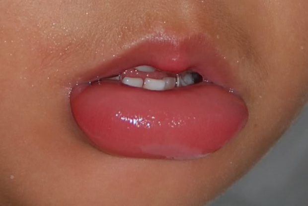 Ожог губы у ребенка от горячей пищи