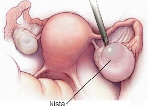 Киста в правом яичнике при беременности