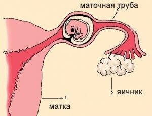 Развитие новообразования после внематочной беременности