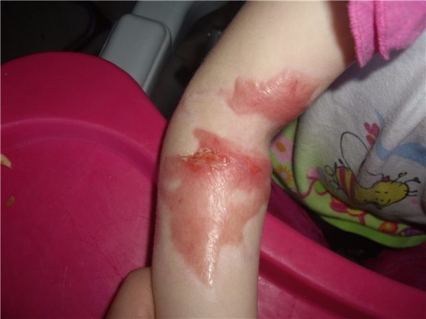 Ожог 3 степени у ребенка на руке