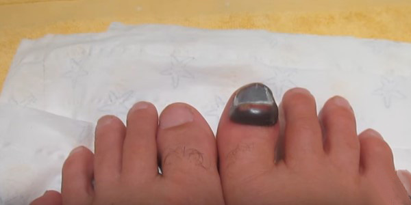 травма ногтя
