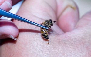пчелоужаливание при повышенном давлении 
