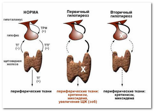 Заболевания щитовидки при отклонениях ТТГ