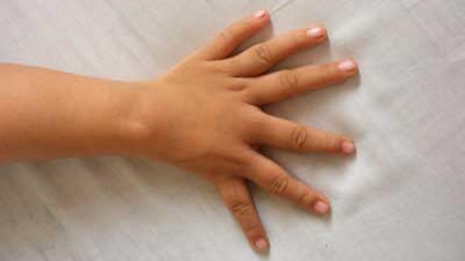 фото 6 пальцев на руке