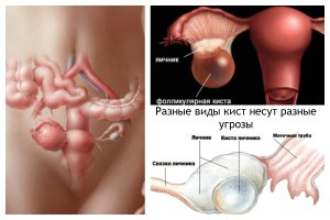 Разновидности кисты и их влияние при зачатии