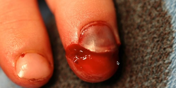 деформация ногтя
