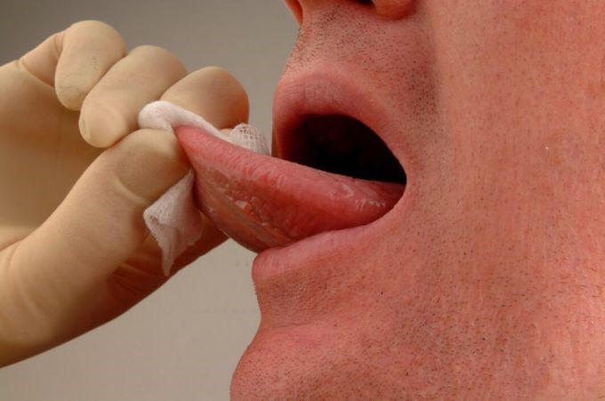 Правильное лечение ожогов слизистой полости рта