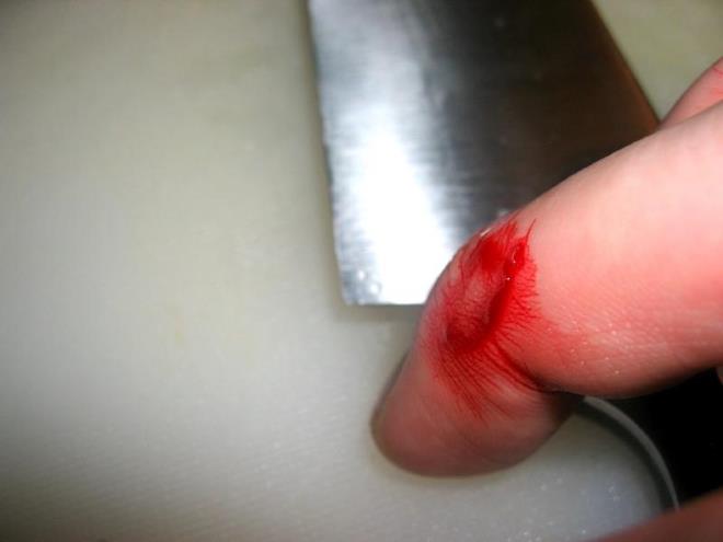 как выглядит глубокий порез пальца кухонным ножом
