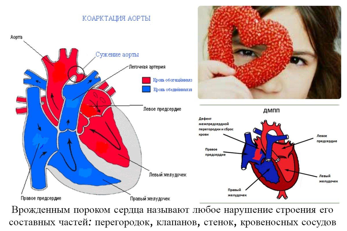 Что такое впс, симптомы и причины врожденного порока сердца у детей